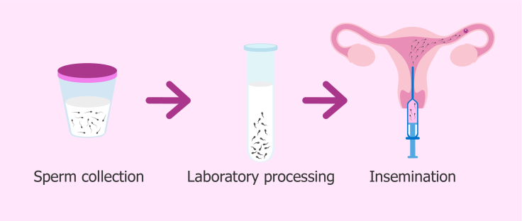 artificial insemination procedure at healthyzer